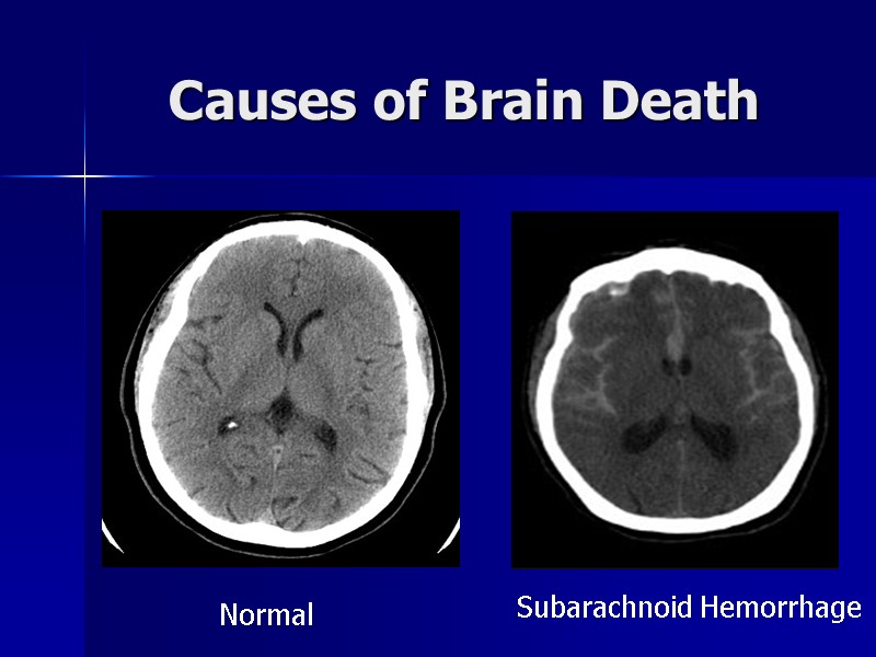 Causes of Brain Death Normal Subarachnoid Hemorrhage